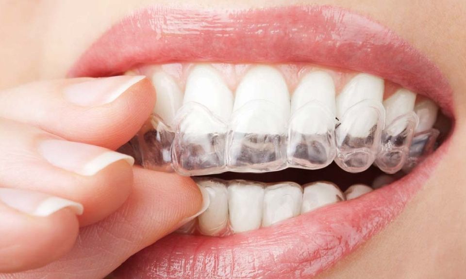Welche Möglichkeiten der Zahnaufhellung für Zuhause gibt es?